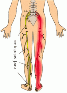 sante-nerf-sciatique-gp3