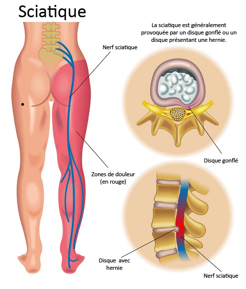 Comment soulager une sciatique  Conseils neurochirurgien Bordeaux